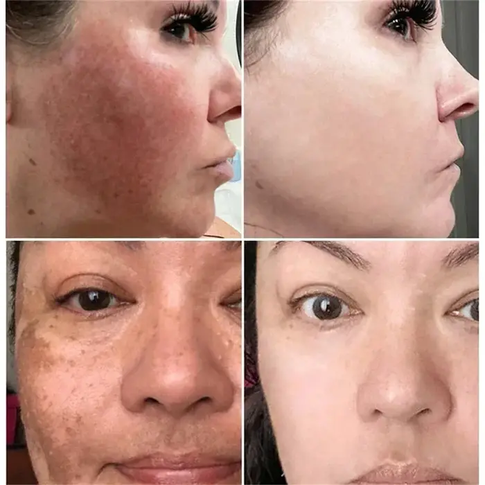 Crème blanchissante puissante anti-taches