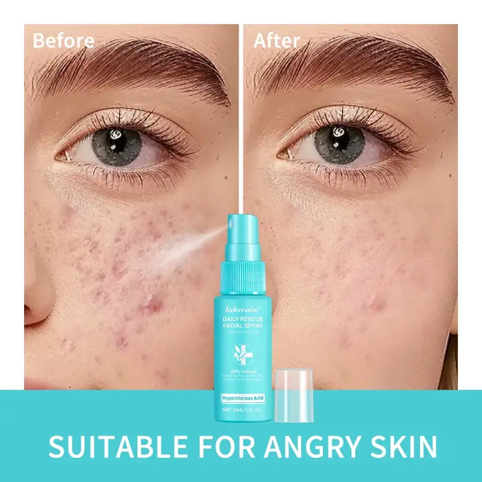 Spray d'acide hypochloreux pour la peau sensible, tonification des rougeurs, soins de la peau, canto
