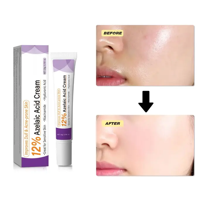 Crème à l'acide azélaïque douce améliore la peau terne, lisse la texture rugueuse, lotion quotidienne non irritante pour le soin du visage.