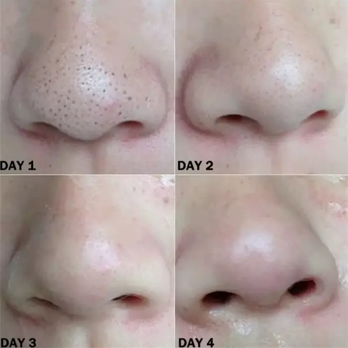 Nez points noirs dissolvant masque bandes nasales tête noire nez