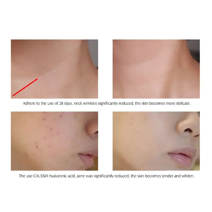 ARTISCARE sérum à l'acide hyaluronique 10 pièces/lot pour le visage hydratant