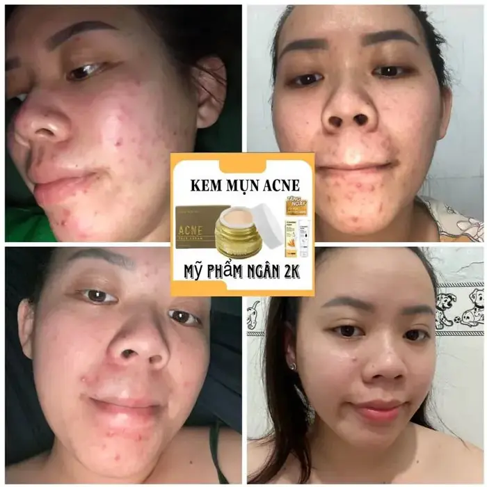 Crème éclaircissante pour le visage Mypham 25g/flacon, réduit l'acné, les taches noires, hydrate la peau, Kem Cot Mun Linh Chi Tang Sua Rua Mat