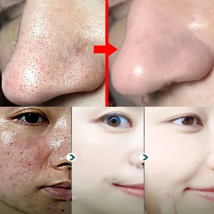 Crème de traitement à l'acide salicylique pour resserrer les pores