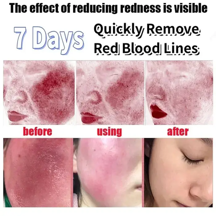 Crème réparatrice pour les rougeurs du visage