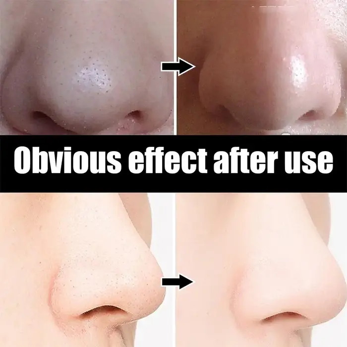 10 pièces points noirs enlever masque bandes nasales rétrécissement nettoyage pores nez tête noire