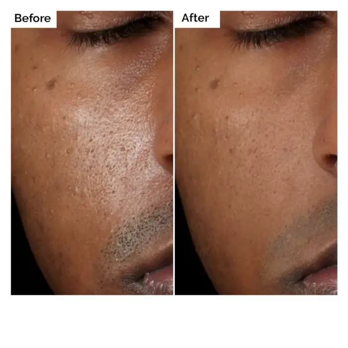 Sérum Solution Aloe 2% + NAG 2% 30 ml pour les marques post-acné améliore la texture de la peau