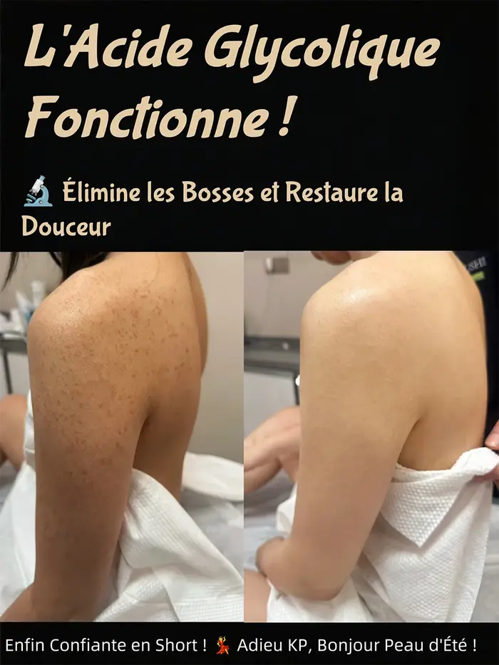 Peeling chimique à l'acide glycolique