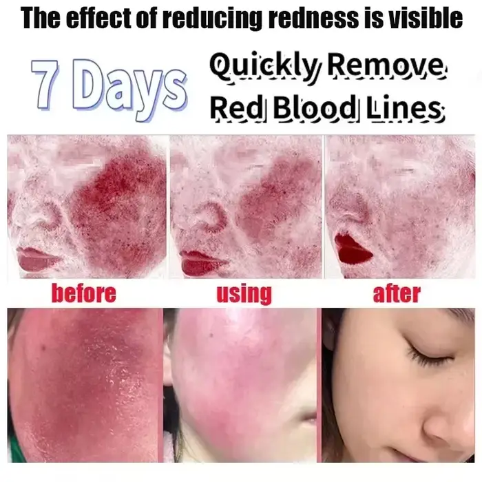 Crème Réparatrice Anti-Rougeurs Visage – Améliore la Peau Sensible et la Sécheresse – Hydratant Apaisant – Élimine la Rosacée – Cosmétiques Coréens