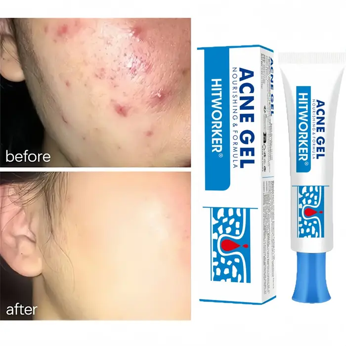 Crème anti-acné à l'acide salicylique, réparation des rougeurs et des boutons, nettoyage en profonde