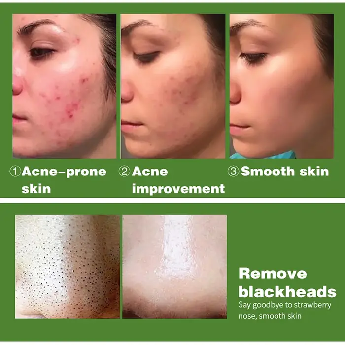 Ensemble de soins du visage anti-acné biologique AILKE