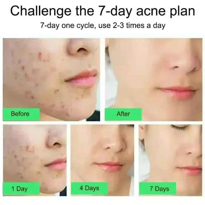 Crème anti-acné à l'acide salicylique