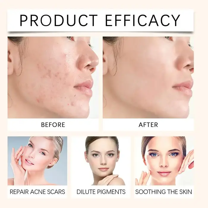 Baume anti-acné de jour avec acide salicylique