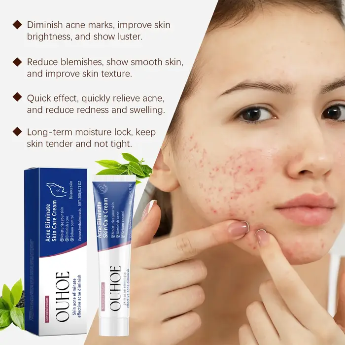 Crème de traitement de l'acné pour le visage