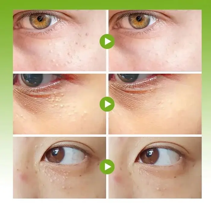Dissolvant de granulés de graisse crème pour les yeux efficace élimine