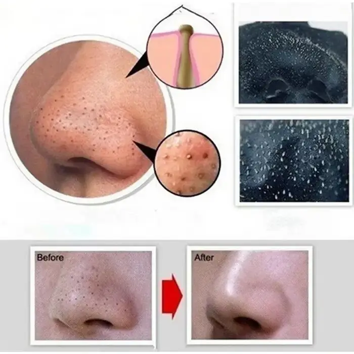 Masque anti-points noirs