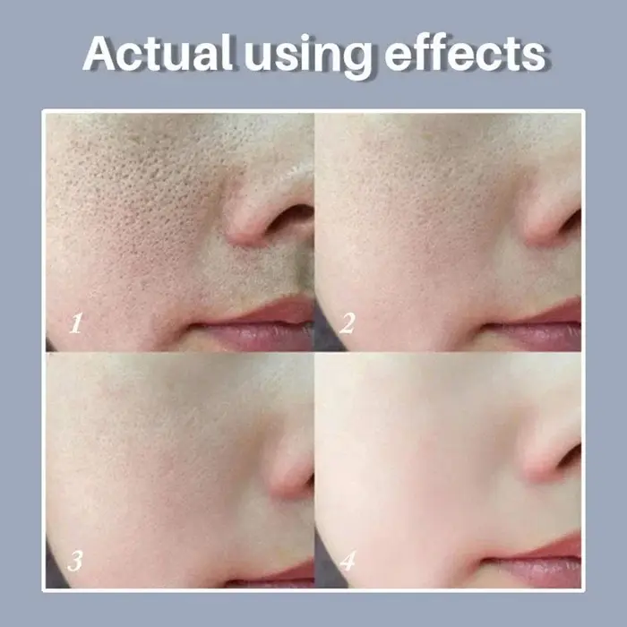 Skin Bergamo | Pore Refining Resurfacing