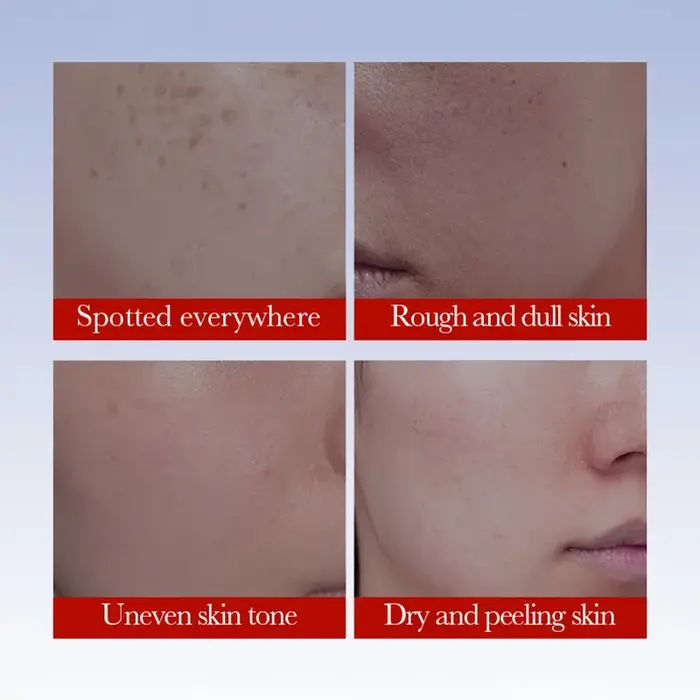 1/3/5 pièces SADOER Anti taches de rousseur crème visage crèmes blanchissantes élimination