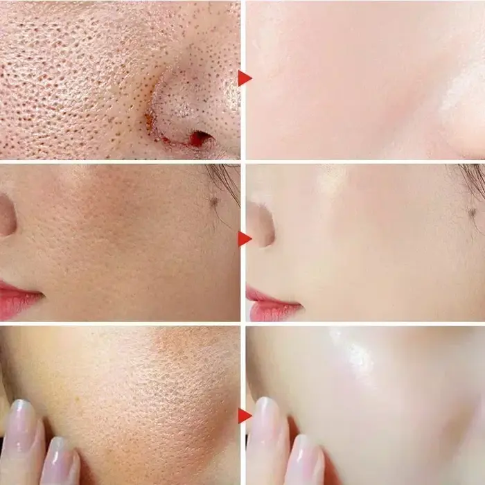 Sérum à l'acide de fruits salicVAC pour le visage