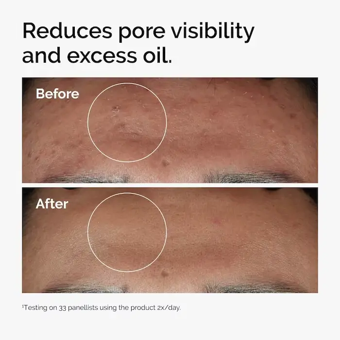 Niacinamide 10% + Zinc 1% sérum 30ml améliore la luminosité de la peau améliorer la Texture réduire l'excès d'huile