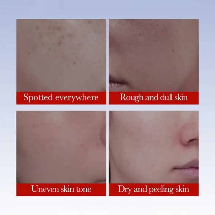 SADOER crème Anti taches de rousseur crèmes éclaircissantes pour le visage élimination