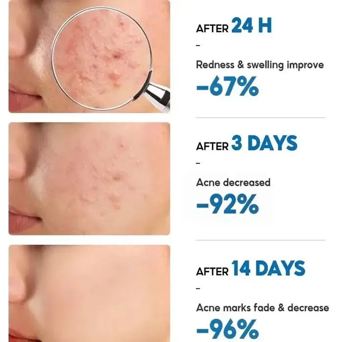 Crème Visage Anti-Acné à Base de Plantes