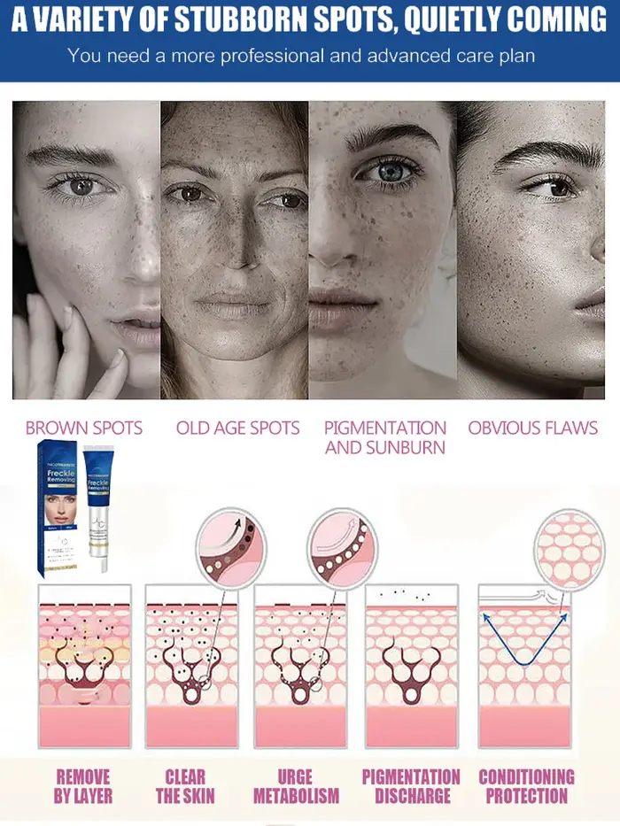 Crème anti-taches foncées efficace pour le visage, élimination des taches de rousseur, des mélasmes, des plaques de soleil, des taches de rousseur