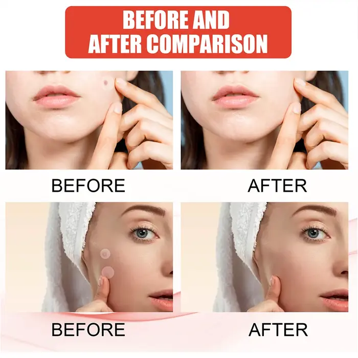 Lot de 144 patchs invisibles professionnels pour le soin de la peau du visage