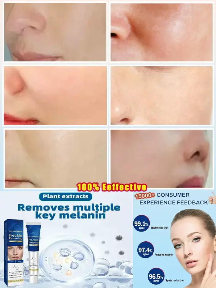 Crème anti-taches foncées efficace pour le visage, élimination des taches de rousseur, des mélasmes, des plaques de soleil, des taches de rousseur