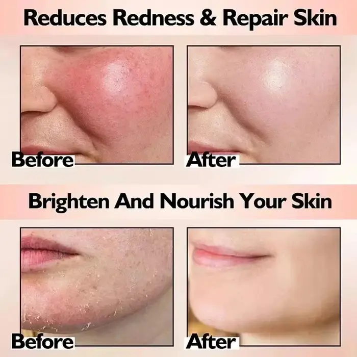 Crème Réparatrice Anti-Rougeurs Visage – Améliore la Peau Sensible et la Sécheresse – Hydratant Apaisant – Élimine la Rosacée – Cosmétiques Coréens
