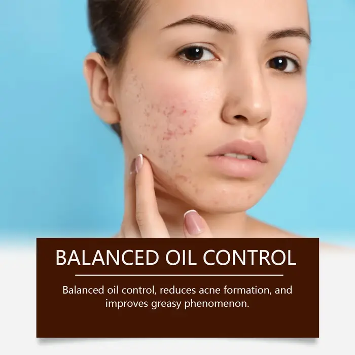 Crème de traitement de l'acné pour le visage